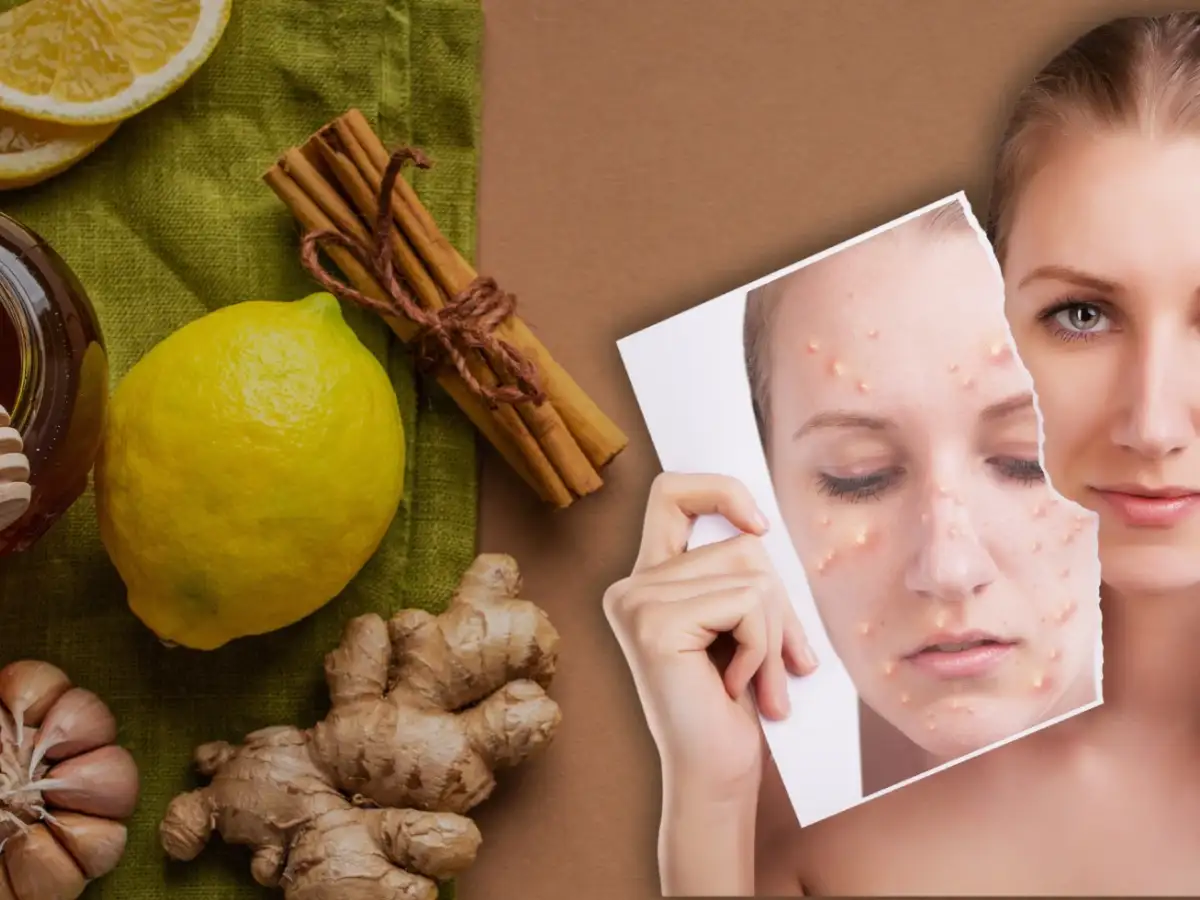 درمان خانگی جوش و آکنه